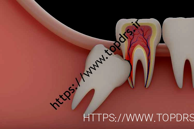 هر آنچه باید در مورد دندان عقل بدانید:
